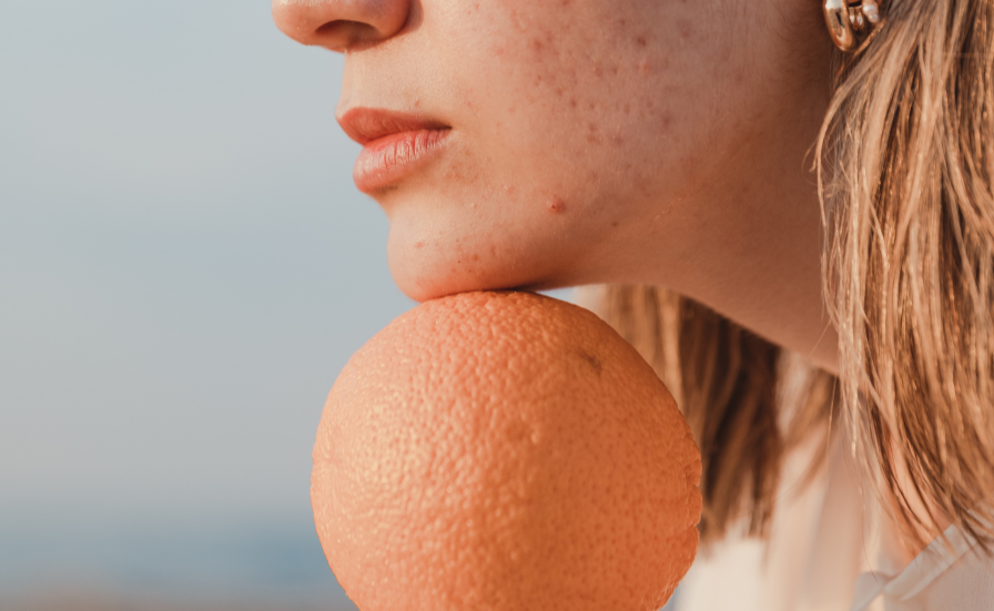 Best Diet for Acne: What to Eat (and Avoid) for acne-free skin